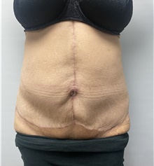 Body Contouring After Photo by Owen Reid, MD; Richmond, BC - Case 48242