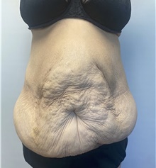 Body Contouring Before Photo by Owen Reid, MD; Richmond, BC - Case 48242