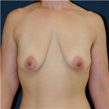 Breast Lift Before Photo by Steve Laverson, MD, FACS; Rancho Santa Fe, CA - Case 48297