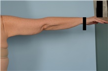 Arm Lift After Photo by Ellen Janetzke, MD; ,  - Case 48352