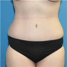 Tummy Tuck After Photo by Joshua Cooper, MD; Seattle, WA - Case 48375