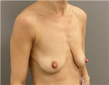 Breast Lift Before Photo by Keshav Magge, MD; Bethesda, MD - Case 48410