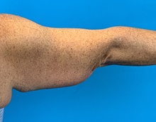 Arm Lift Before Photo by Eric Wright, MD; Little Rock, AR - Case 48575