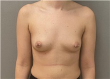 Breast Augmentation Before Photo by Keshav Magge, MD; Bethesda, MD - Case 48597