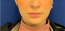 Botulinum Toxin After Photo by Munique Maia, MD; ,  - Case 48753