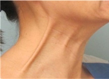 Botulinum Toxin Before Photo by Munique Maia, MD; ,  - Case 48757