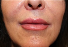 Lip Augmentation/Enhancement After Photo by Ellen Mahony, MD; Westport, CT - Case 48760