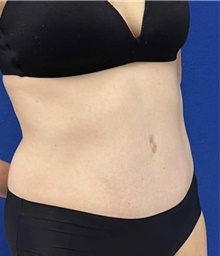 Tummy Tuck After Photo by Munique Maia, MD; ,  - Case 48932