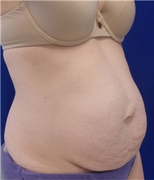 Tummy Tuck Before Photo by Munique Maia, MD; ,  - Case 48932