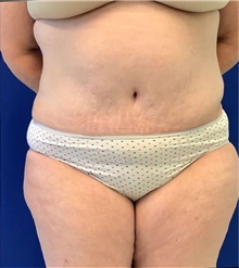 Tummy Tuck After Photo by Munique Maia, MD; ,  - Case 48941