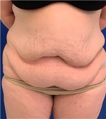 Tummy Tuck Before Photo by Munique Maia, MD; ,  - Case 48941