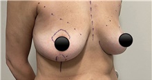 Breast Augmentation Before Photo by Munique Maia, MD; ,  - Case 48972