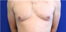 Male Breast Reduction Before Photo by Munique Maia, MD; ,  - Case 48992