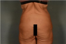 Body Lift Before Photo by Ellen Janetzke, MD; ,  - Case 49278