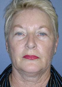 Dermal Fillers After Photo by James Lowe, MD; ,  - Case 6769