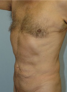 Male Breast Reduction After Photo by Susan Kaweski, MD; La Mesa, CA - Case 8000