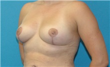Breast Augmentation After Photo by Scott Sattler, MD,  FACS; Seattle, WA - Case 50442