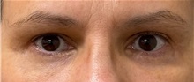 Eyelid Surgery After Photo by Keshav Magge, MD; Bethesda, MD - Case 50511