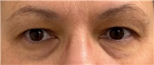 Eyelid Surgery Before Photo by Keshav Magge, MD; Bethesda, MD - Case 50511