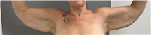 Arm Lift Before Photo by Keshav Magge, MD; Bethesda, MD - Case 50501