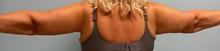 Liposuction After Photo by Julia Spears, MD, FACS; ,  - Case 50575