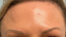 Botulinum Toxin After Photo by Julia Spears, MD, FACS; ,  - Case 50651