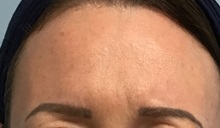 Botulinum Toxin After Photo by Julia Spears, MD, FACS; ,  - Case 50779