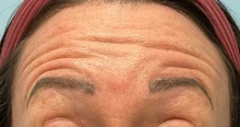 Botulinum Toxin Before Photo by Julia Spears, MD, FACS; ,  - Case 50779