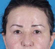 Brow Lift After Photo by Lisa Brostrom, MD; San Antonio, TX - Case 49922