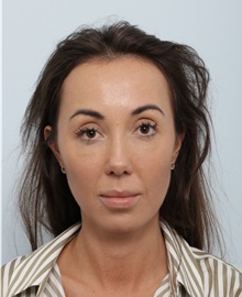 Chin Augmentation After Photo by Paul Vitenas, Jr., MD; Houston, TX - Case 50005