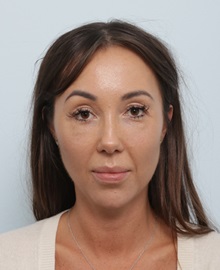 Chin Augmentation Before Photo by Paul Vitenas, Jr., MD; Houston, TX - Case 50005