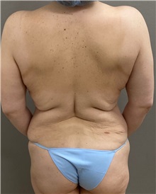 Body Contouring Before Photo by Keshav Magge, MD; Bethesda, MD - Case 50202