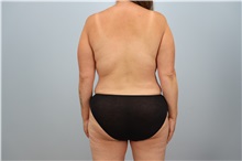 Mommy Makeover After Photo by Keith Neaman, MD; Salem, OR - Case 50241