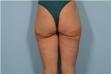Thigh Lift After Photo by Ellen Janetzke, MD; ,  - Case 49316