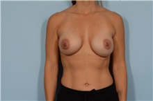 Breast Augmentation After Photo by Ellen Janetzke, MD; ,  - Case 49302