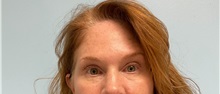 Botulinum Toxin After Photo by Julia Spears, MD, FACS; ,  - Case 49308
