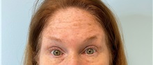 Botulinum Toxin Before Photo by Julia Spears, MD, FACS; ,  - Case 49308
