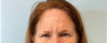 Botulinum Toxin Before Photo by Julia Spears, MD, FACS; ,  - Case 49308