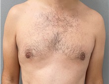 Male Breast Reduction After Photo by Keshav Magge, MD; Bethesda, MD - Case 49406