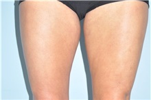 Thigh Lift After Photo by Keyian Paydar, MD, FACS; Newport Beach, CA - Case 49601