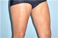 Thigh Lift Before Photo by Keyian Paydar, MD, FACS; Newport Beach, CA - Case 49601