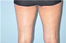 Thigh Lift After Photo by Keyian Paydar, MD, FACS; Newport Beach, CA - Case 49601