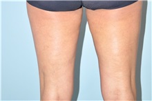 Thigh Lift Before Photo by Keyian Paydar, MD, FACS; Newport Beach, CA - Case 49601