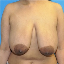 Breast Reduction Before Photo by Joshua Cooper, MD; Seattle, WA - Case 49656