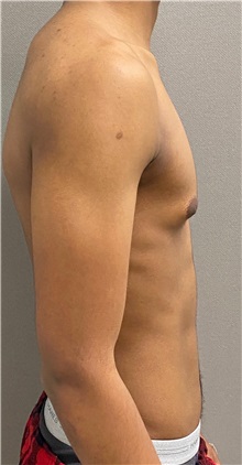 Male Breast Reduction Before Photo by Keshav Magge, MD; Bethesda, MD - Case 49658
