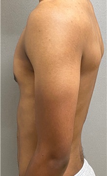Male Breast Reduction After Photo by Keshav Magge, MD; Bethesda, MD - Case 49658