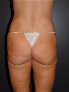 Body Lift Before Photo by Michele DeVito, MD, FACS; Scottsdale, AZ - Case 49667