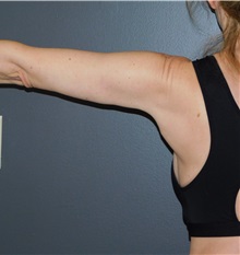 Arm Lift After Photo by Michele DeVito, MD, FACS; Scottsdale, AZ - Case 49665