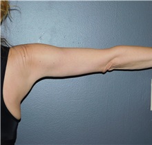 Arm Lift After Photo by Michele DeVito, MD, FACS; Scottsdale, AZ - Case 49665