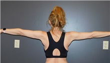 Arm Lift After Photo by Michele DeVito, MD, FACS; Scottsdale, AZ - Case 49665